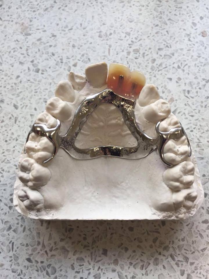Chrome Denture Dental Blog Adam Norris Dental Labaratory