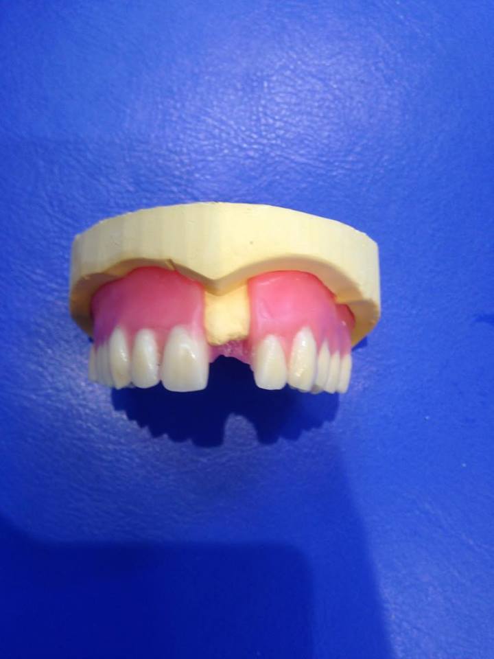 Add Of Tooth Dental Blog Adam Norris Dental Labaratory