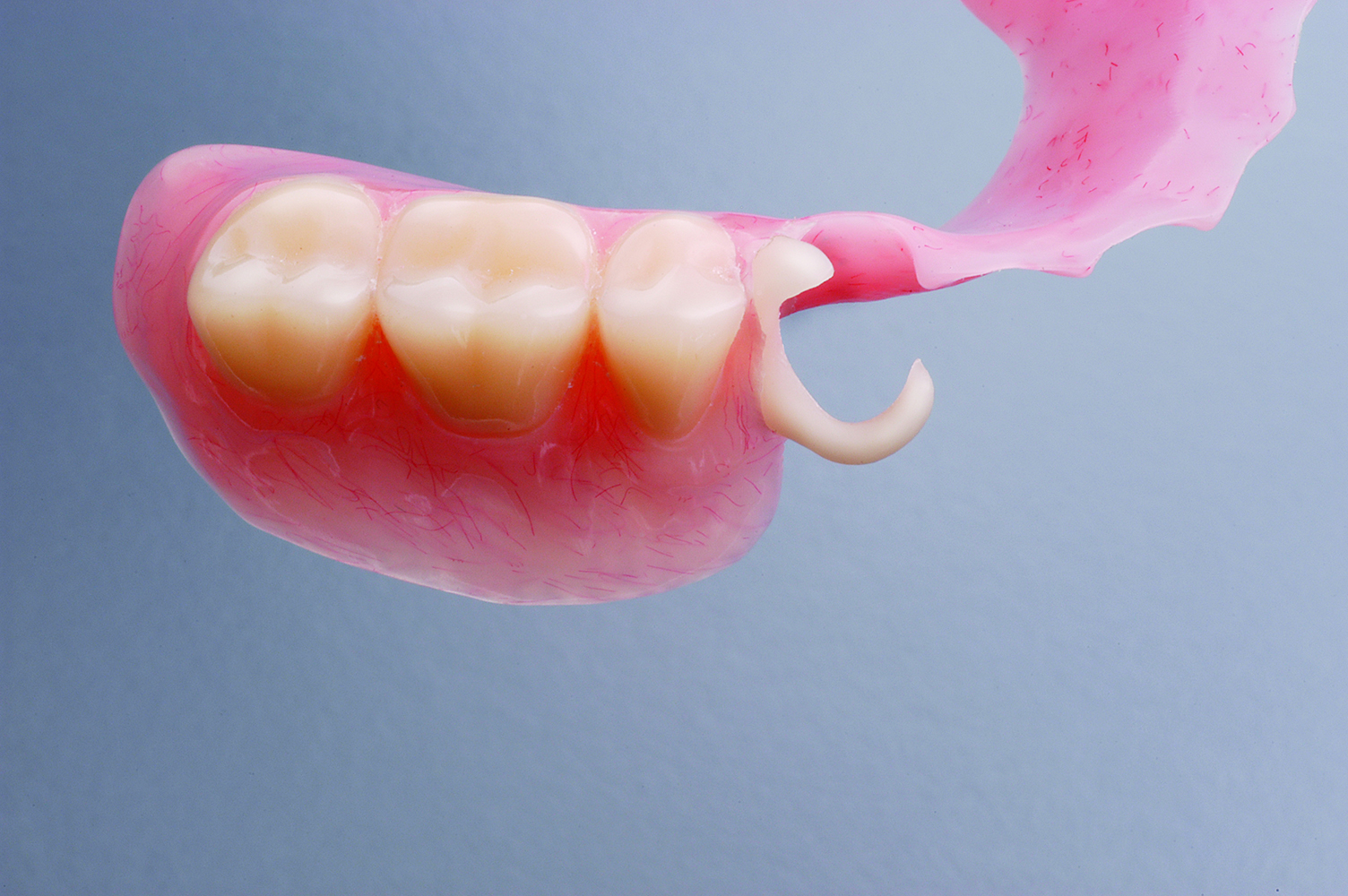 Tooth Clasps Dental Blog Adam Norris Dental Labaratory