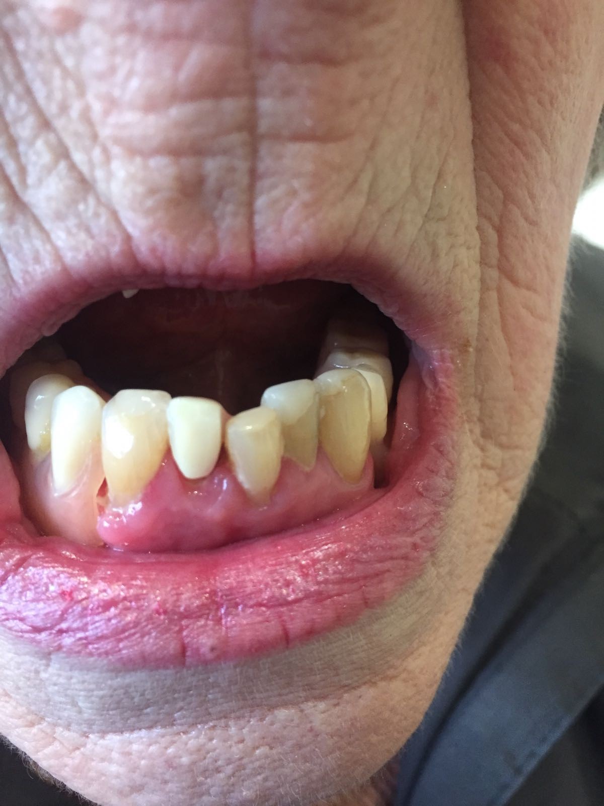 New Dentures Dental Blog Adam Norris Dental Labaratory