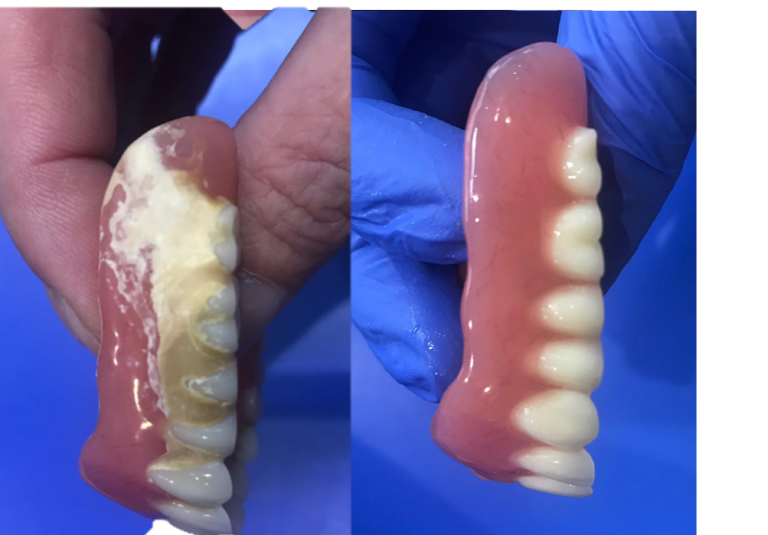 Clean Dentures Dental Blog Adam Norris Dental Labaratory