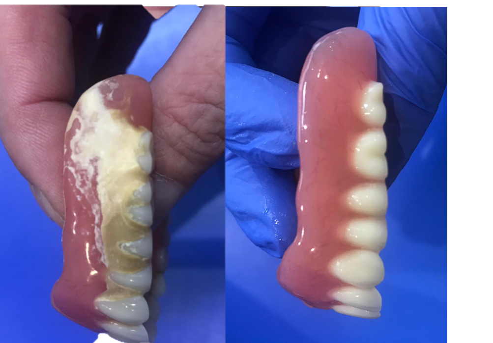 Clean Dentures Dental Blog Adam Norris Dental Labaratory